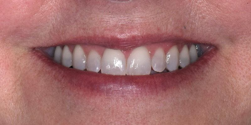 smile-gallery-1-after-pearl-dentistry