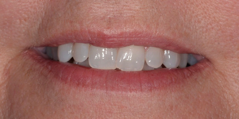 smile-gallery-1-before-pearl-dentistry