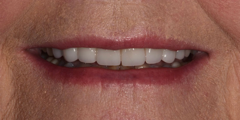 smile-gallery-3-after-pearl-dentistry